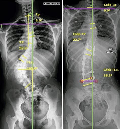 Scielo Brasil What Is The Best Distal Level Of Arthrodesis In