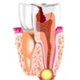 Peri Implantitis Infection Of A Dental Implant