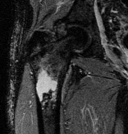 Enchondroma Vs Low Grade Chondrosarcoma Radiology Reference Article