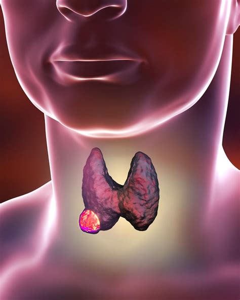 Parathyroid adenoma - Dr Justin Gundara