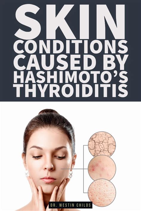 Hashimoto Thyroid Skin Rash Pictures