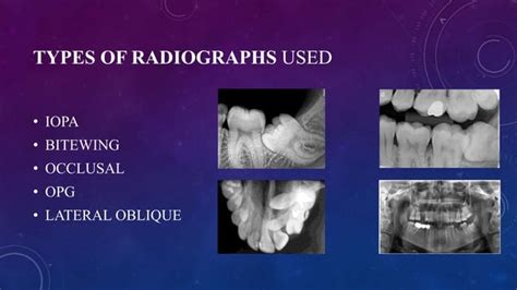 Radiographic Assessment Of Impacted Teeth Pptx