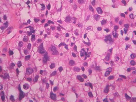 EPENDYMOMA – Histopathology.guru