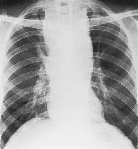 Radiology Pearls Tuberculosis