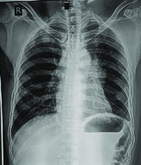 Chest X Ray PA View Showing Mediastinal Mass PA Posteroanterior