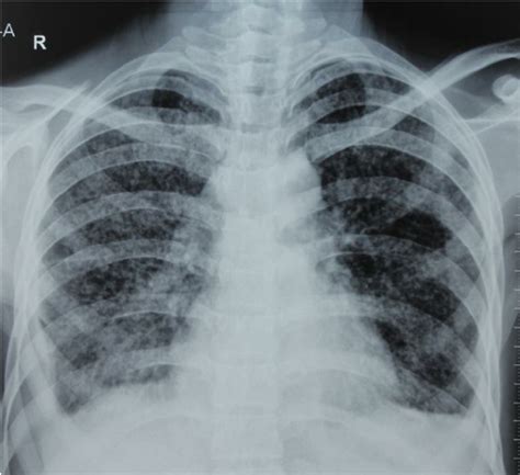 Chest X Ray Miliary Tb