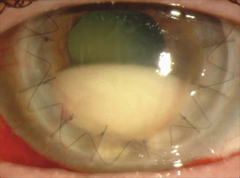 Acanthamoeba Endophthalmitis Following Penetrating Keratoplasty For Acanthamoeba Keratitis