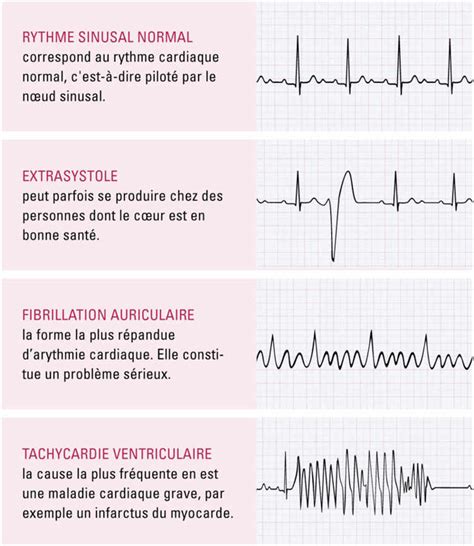 Les Troubles Du Rythme Cardiaque Planete Sante