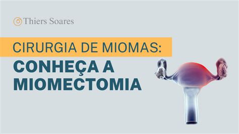 Cirurgia de miomas conheça a miomectomia Dr Thiers