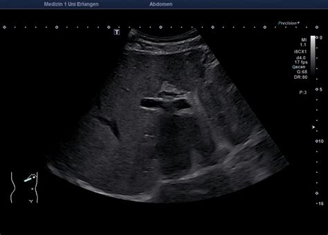 Nebennierenver Nderungen Sonographieatlas Erlangen