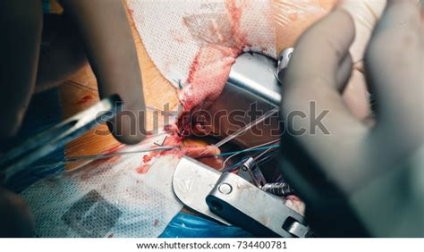 Team Surgeons Operating Wearing Lamp Lighting Stock Photo 734400781