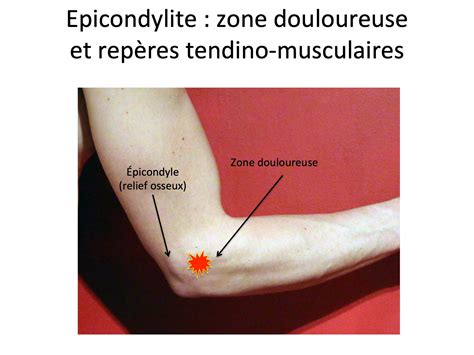 Epicondylite Tennis Elbow Centremainsauvegarde