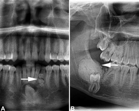 Odontoma