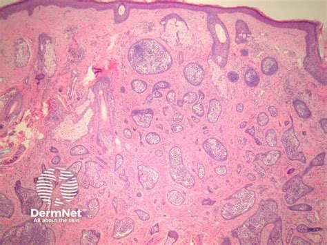 Cutaneous Lymphadenoma Pathology