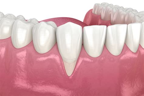 Understanding Gum Recessions Causes And Solutions Gorbatov Dentistry Your Dentist In