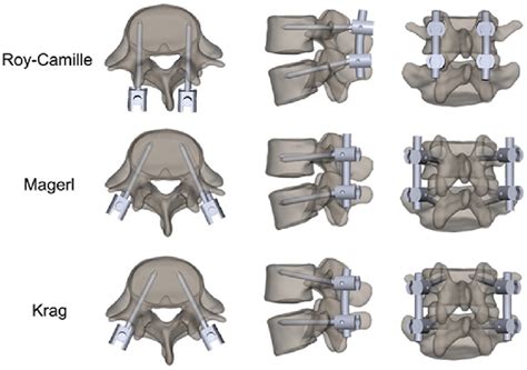 The Methods Of Three Pedicle Screw Insertion Techniques From Top To Download Scientific