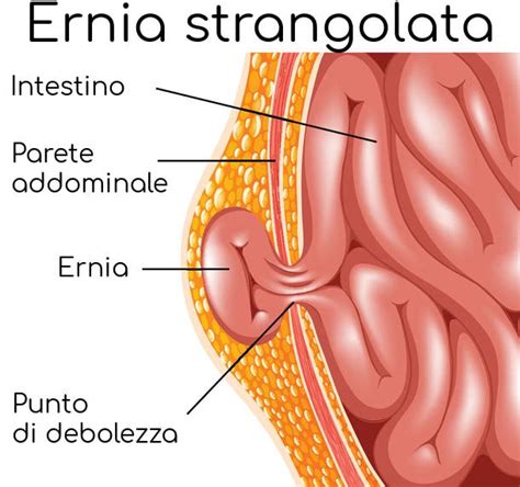 Ernia Ombelicale Sintomi Intervento Cause