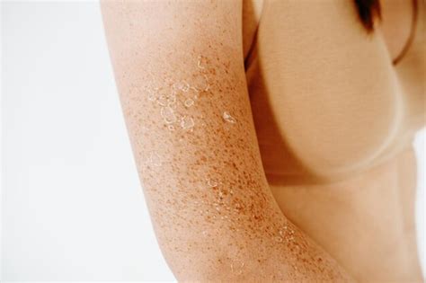 Premium Photo Peeling Skin After Sunburn Dermatology Problems At