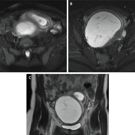 Axial T2 Weighted Fat Saturated Mr Images Show The Early Gestational