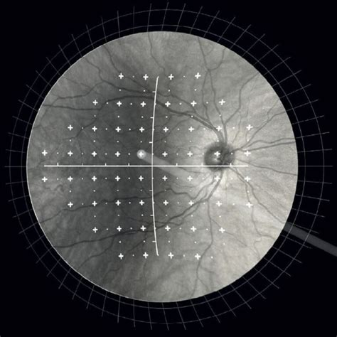 Icare Compass Fundus Automated Perimeter