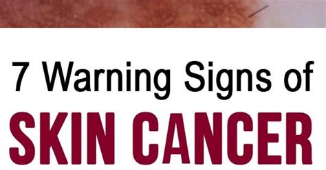 7 SKIN CANCER WARNING SIGNS YOU SHOULD NEVER IGNORE Medicine Health Life