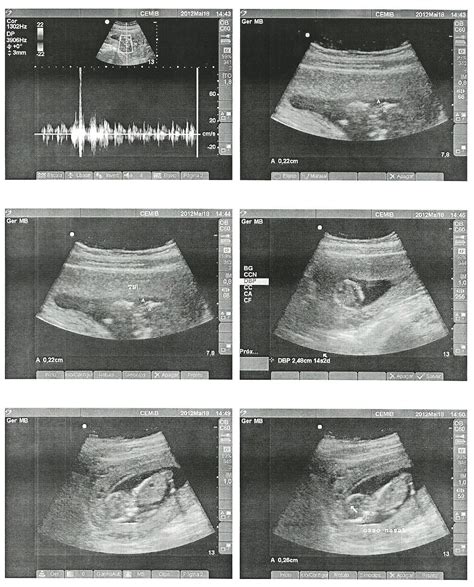 Muito Grávida do Bernardo Ultrassonografia Morfologica 1º Trimestre