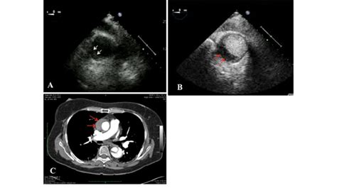 A Short Axis Standard Tee Imaging Of The Ascending Aorta A Crescent