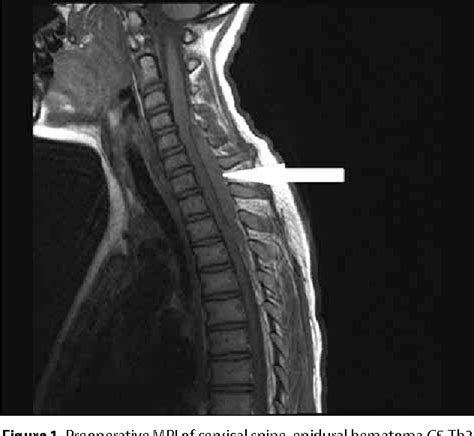 Figure 1 From Cervical Epidural Hematoma Case Report Semantic Scholar