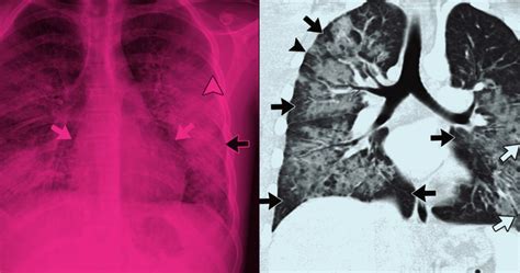 Cigarro eletrônico causa doença pulmonar denominada Evali