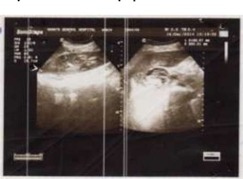 Figure 1 From RECURRENT PERI OP HAEMATURIA IN REPEAT LOWER SEGMENT