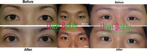 Asian Blepharoplasty Eyelid Surgery Thailand - Urban Beauty Thailand