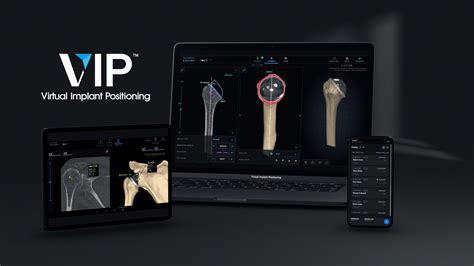 Arthrex Now Available In The Vip Preoperative Planning System