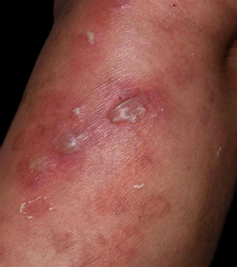 Vesicular Skin Lesions Causes Symptoms Diagnosis Treatment The Best