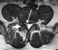 Lateral Recess Stenosis | Spine Specialist