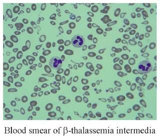 Thalassemia - The Inherited Blood Disorder: Beta Thalassemia