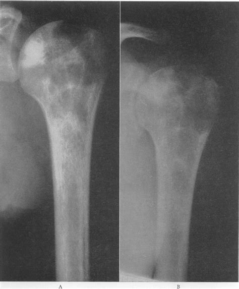 Salmonella Osteomyelitis In Patients With Sickle Cell Anemia NEJM