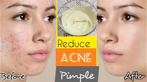 How To Clear Acne And Pimples Treatment Of Acne Get Rid Of Acne And