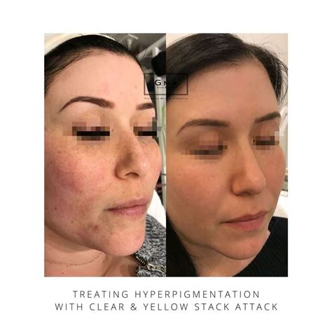 Top Hyperpigmentation Treatments The Grand Medical Aesthetics