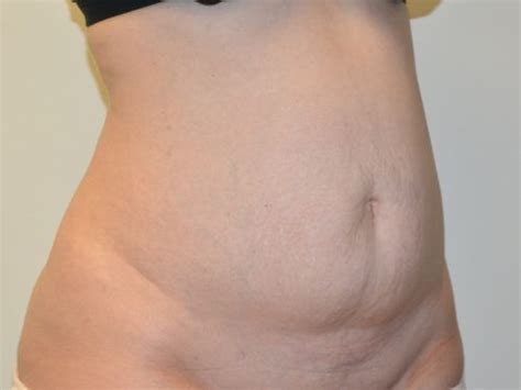 Tummy Tuck 30 Before After Gallery Allen Doezie MD FACS