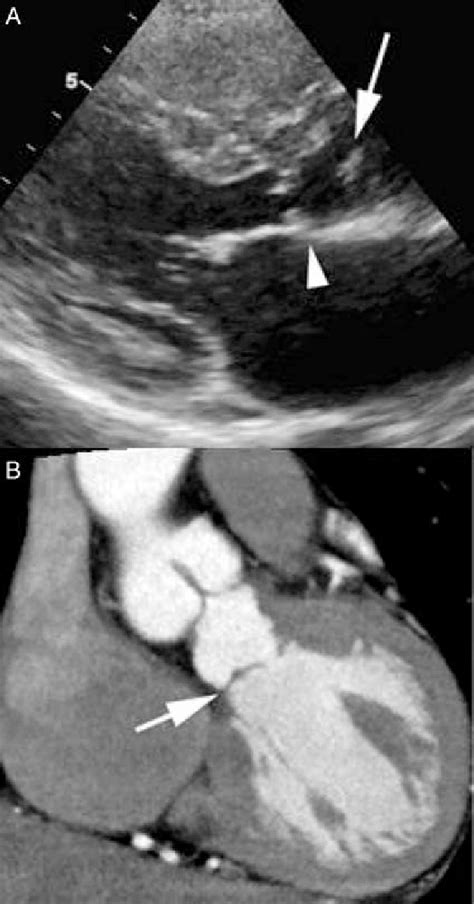 A Parasternal Long Axis Echocardiogram Showing The Subaortic Membrane