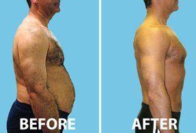 Fat Reduction Laser Naked Images Comments 2