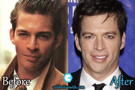 Harry Connick Jr Plastic Surgery, Botox, Jaw Surgery, Before After Pics - CelebritiesWith.com