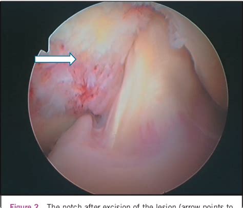 Figure From Inverted Cyclops Lesion After Anterior Cruciate Ligament