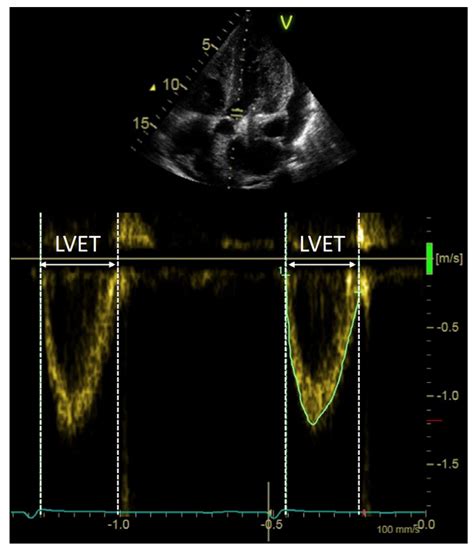 Jcm Free Full Text Value Of Left Ventricular Indexed Ejection Time