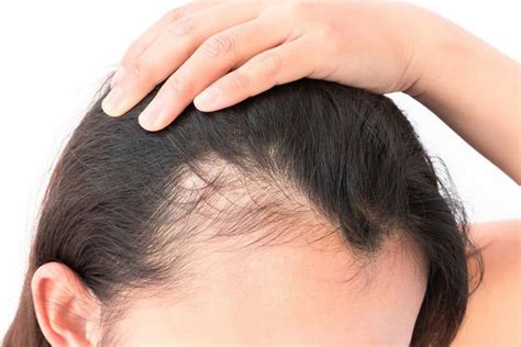 Calv Cie Feminina Alopecia Androgen Tica Dermatologista Porto