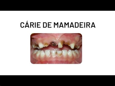 Cárie na primeira infância ou cárie de mamadeira YouTube