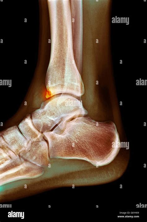 Bone Spur High Resolution Stock Photography And Images Alamy