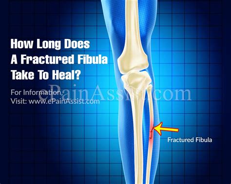 5 Shocking Truths About Recovering From A Broken Fibula