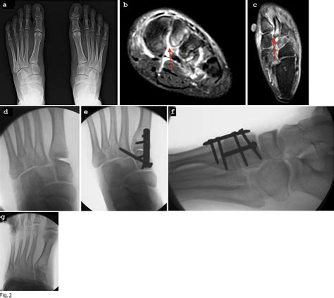 Figure From Lisfranc Injury In The Athlete Semantic Scholar