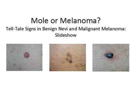 Early Stage Melanoma Images